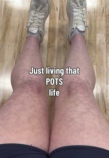 #POTS #livedoreticularis #orthostaticintolerance #posturalorthostatictachycardiasyndrome #bloodpooling