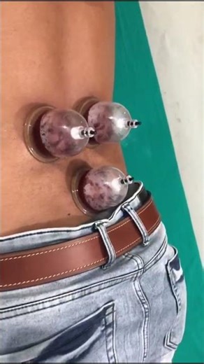 #hijama #hijamabenefits #hijamacupping #hijamacupping