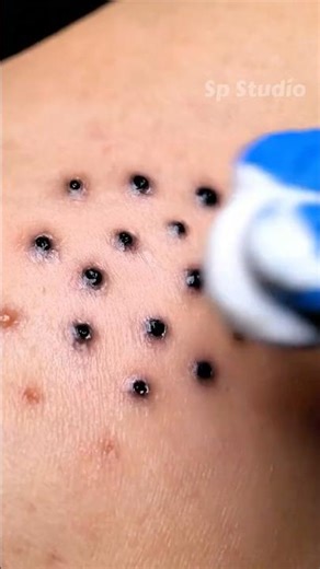 Oddly Satisfying Skin Extraction ASMR ✨ #oddlysatisfying #asmr #satisfying #skincare #asmr #viral