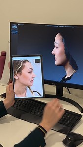 Russian Lips is a term that gets mentioned a lot, but the technique behind it is often misunderstood. Watch to learn how this shaping approach focuses on vertical structure, how it differs from other lip techniques, and why individual anatomy plays a key role in treatment planning. Results may vary between individuals and depend on personal goals, baseline characteristics, and responses to treatment. A consultation with a qualified medical professional is recommended to determine if this treatme