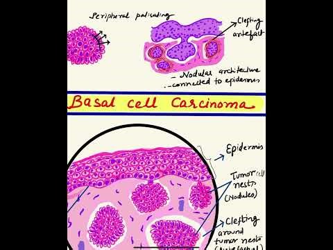 #letsdrawBCC #microscopymadeeasy #rodent ulcer Basal Cell carcinoma step by step | DR.MITHILA |