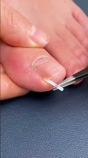 ✅ Effective toenail care for foot pain ( # 2553 ) - Toe Nail Support Pad