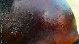 A close-up of a black male face showing the early stages of monkeypox, with red, raised lesions spreading across the cheeks and forehead, emphasizing the initial symptoms of the disease.