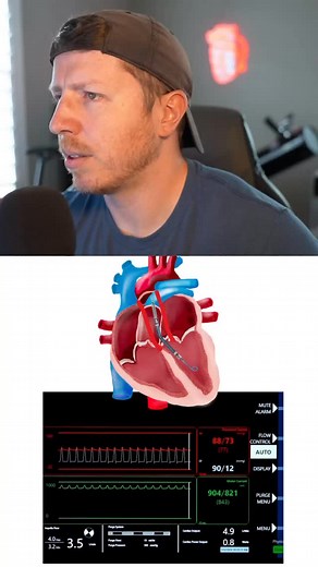 What even is the motor current waveform on the Impella? What does it mean? . Check out the ICU STARTER BUNDLE and the other Nurse Dose Cheat Sheets/Resources in the bio! . Follow for more ICU nursing education! 🎓 . #cvicu #cardiacnurse #criticalcare #nursingschool #icunurse #newgradnurse #newgradrn #nursesofinstagram #icunurselife #flightnurse #criticalcarenurse #emergencydepartment #nurselife #paramedic #ernurses #medicalstudents | Nurse Dose Podcast