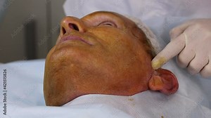 Thread lifting for a male patient is an innovative method of correcting face lifting with special ultra-thin and durable threads with multidirectional notches.