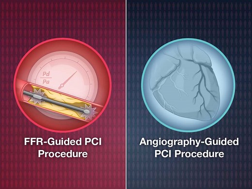 In patients with STEMI and multivessel disease, PCI for nonculprit lesions is superior to culprit lesion treatment alone. Whether an FFR-guided approach results in better clinical outcomes than an angiography-guided approach for complete revascularization is unclear. https://nej.md/36PxyKc | The New England Journal of Medicine