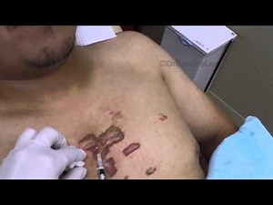 Using my Gopro: Treating keloids with IL steroids and Vbeam For medical education- NSFE.