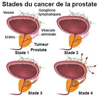 Cancer de la prostate : symptômes, traitement, définition