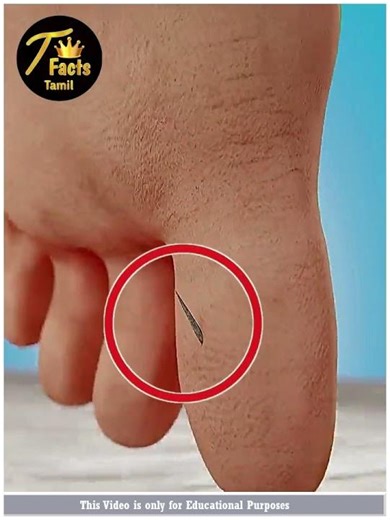 Remove Splinter From foot like this 😱😱 !!!