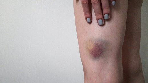 Here’s Why You Bruise So Easily, According to a Doctor