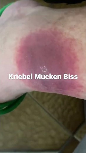 Kriebelmücken biss Katastrophe