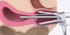 Basics of Hysteroscopy - TVASurg - The Toronto Video Atlas of Surgery