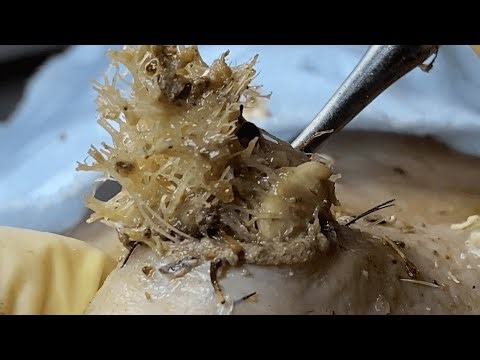 Boogerswax removal | Booger clean |Giant Boogerswax 1109