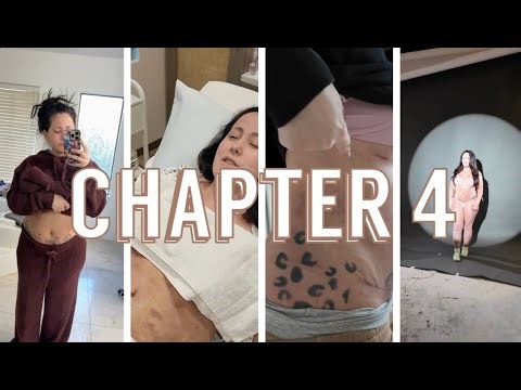 Tummy Tuck Journey - Ch. 4 Three Weeks Post-Op