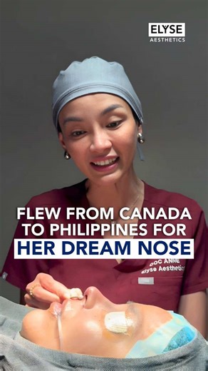 No-Implant Rhinoplasty and Septoplasty for Better Symmetry