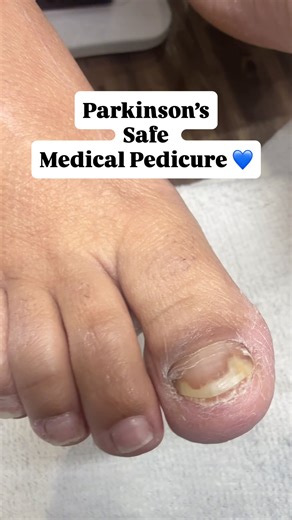 This is why medical pedicures exist. 💙 My client has Parkinson’s—lifted nails, discoloration, peeling skin & erratic movements. Traditional salons can’t safely serve her due to lack of sterilization & medical training. As a Certified Medical Nail Technician, I’m educated on assisting clients with neurological conditions to prevent cuts & injury. She’s healing with monthly treatments. Book yours! 👇 🆓 FREE foot health assessments ➡️ Link in bio #medicalpedicure #parkinsonsawareness #medicalnail