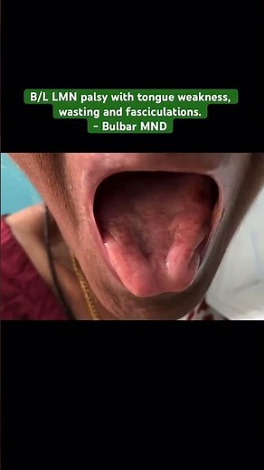 Bulbar Motor Neuron disease -B/L LMN palsy - tongue weakness, wasting & fasciculations. #neurology