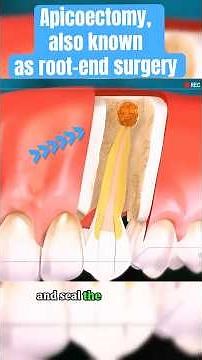 Apicoectomy, also known as root-End Surgery