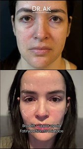 Browlift upper eyelid,fatinjection to midface In Turkey