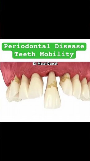 Periodontal Disease, Teeth Mobility