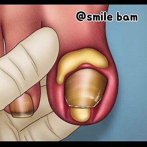 Ingrown toenail treatment animation part2 #smilebam #animation #makeup #asmr #care #satisfying #makeup #soonent #zombie #fypシ | Daily Hobbies