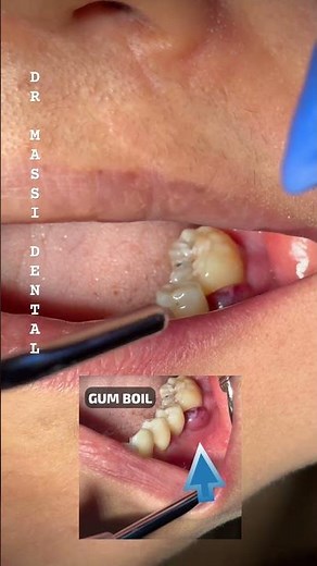 GUM BOIL what’s that