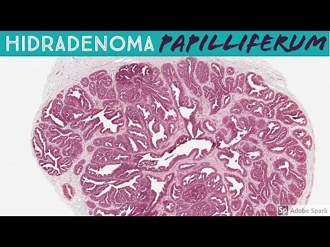 Hidradenoma Papilliferum: 5-Minute Pathology Pearls