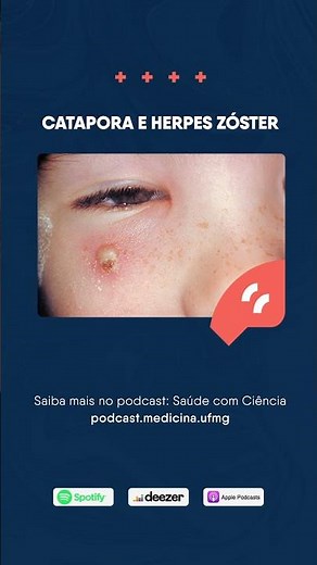Saúde com Ciência | Catapora e herpes zóster