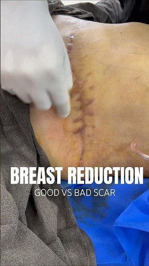 Breast Reduction Surgery Scars: Good vs Bad Surgical Planning | Dr Amit Gupta