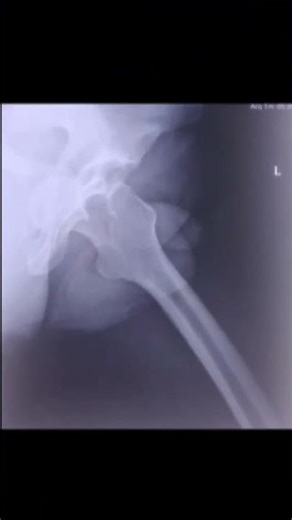Posterior dislocation of Hip @ALLIS reduction maneuveur