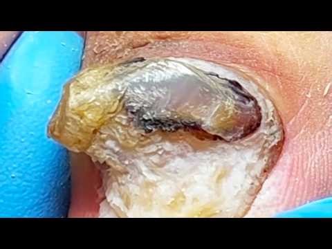 Most Satisfying Paronychia Treatment | Relieve Pain & Remove Black Mud【Podiatry Clinic】