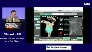 Reverse Shoulder Prosthesis is the Best Choice