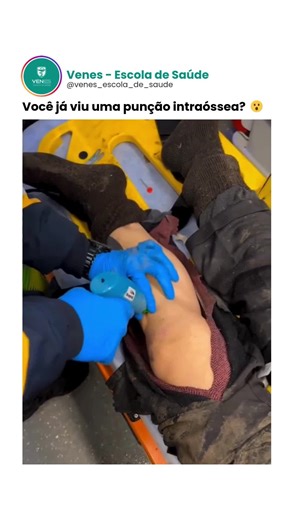 Venes - Escola de Saúde | A punção intraóssea é uma técnica que pode salvar vidas em situações de emergência, quando o acesso venoso convencional é inviável. Você... | Instagram