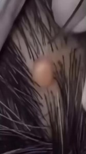 #acne #pimples #acnecare #blackheadacne #popping #acnecare #skincare #acnetreatment #acne #acnescars #acnefree #acneproblems#327 | Dr.pimplepop-Fan | Facebook