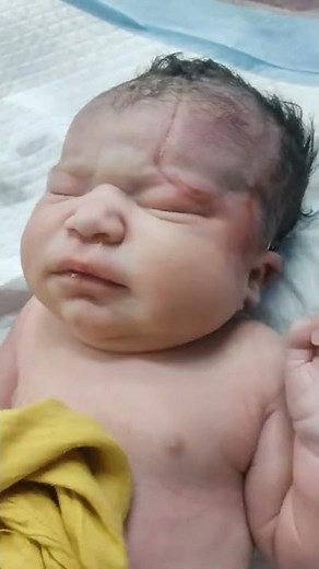 Difficult birth of a newborn baby delivered via forceps with first cry #shorts