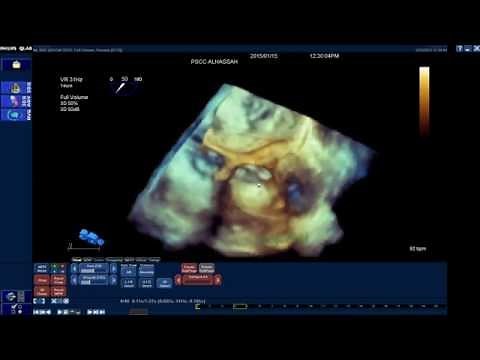 How to assess the Aortic root dimensions by 3D-TEE (Q-lab)