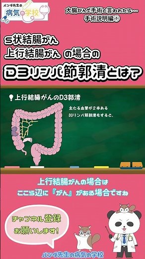 S状結腸がん・上行結腸がんの場合のD3リンパ節郭清とは？