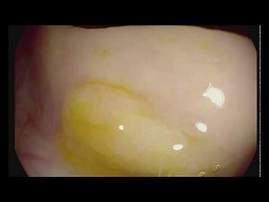 EMR of a sessile serrated adenoma