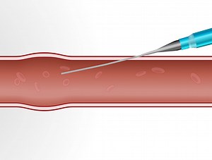 Arterial Line Placement: Over-the-Wire and Over-the-Needle