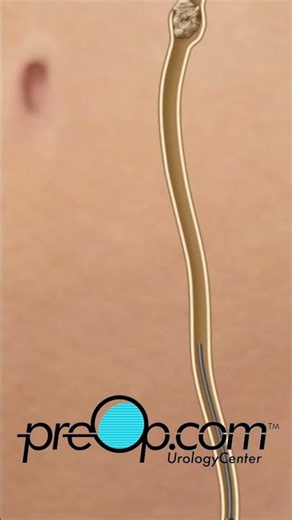 🔍 PreOp® Kidney Stone Ureteroscopy 💡 Preventing Future Stones ✨ #shorts
