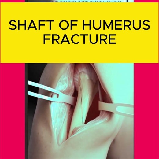 The Secret to Humerus Fracture Correction You Don't Know