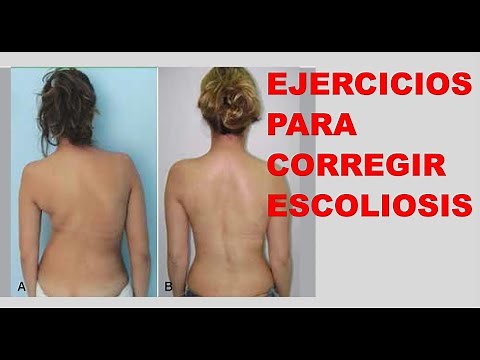 How to correct scoliosis