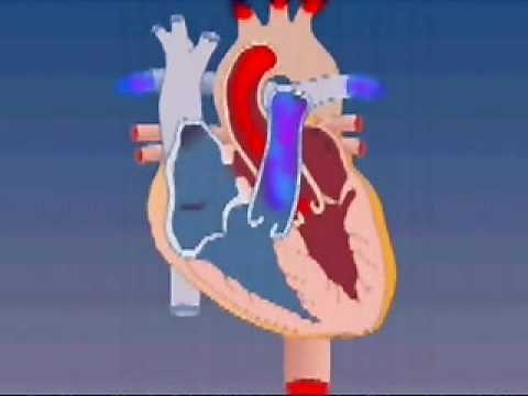 Atrial Septal Defect