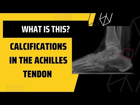 Calcifications in the Achilles Tendon?? OUCH!