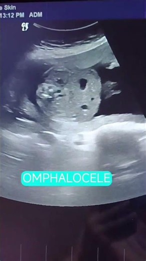 Never Skip This View in Every Fetal Anomaly Scan | Umbilical Cord Insertion #sonography #baby
