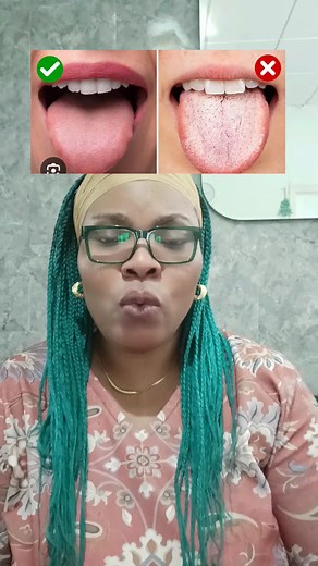 What to do if your tongue is white | Susan Herbal Tips