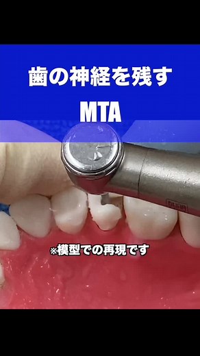 歯の神経を残す治療方法とMTAの重要性