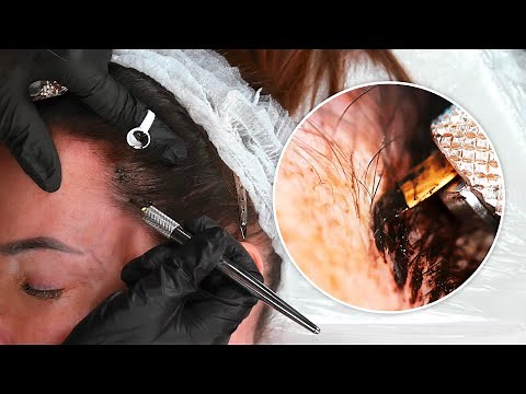 Hairline Microblading Tattoo to solve Hair Loss | FULL PROCESS