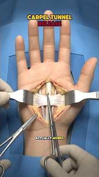 Carpal Tunnel Release Surgery Explained (3D Animation) — Open vs Endoscopic #shortvideo