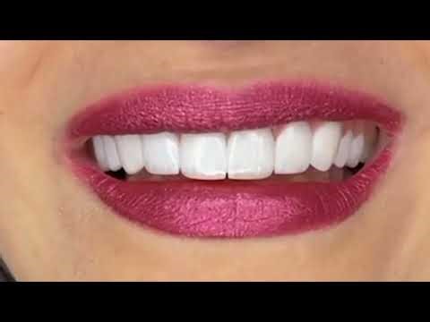 InstaSmile Clip on Teeth Veneers Closeup